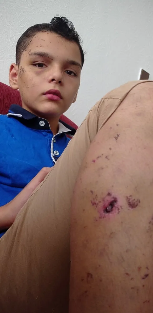 A close-up of a child with scabs and wounds on his leg.